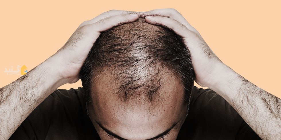 برای جلوگیری از ریزش مو چه کنیم؟ + اینفوگرافیک